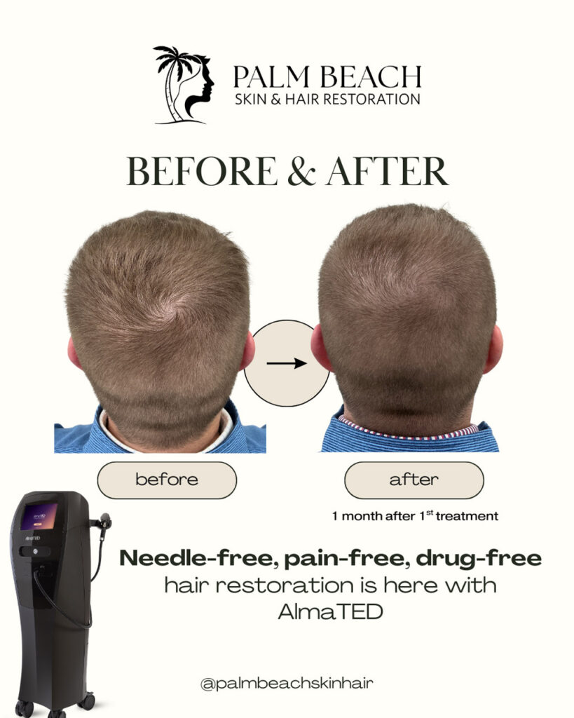 before and after hair restoration with AlmaTED